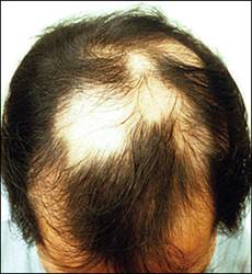 Nguyên nhân gây rụng tóc từng mảng