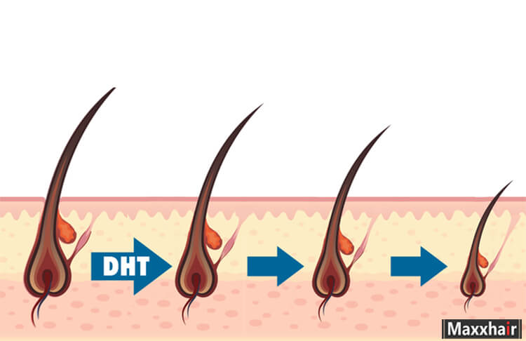 DHT khiến tóc rụng nhanh và khó mọc lại, dẫn đến hói đầu
