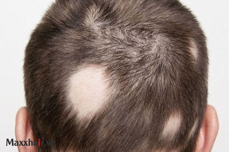 Rụng tóc nam giới Nguyên nhân và cách điều trị phòng ngừa