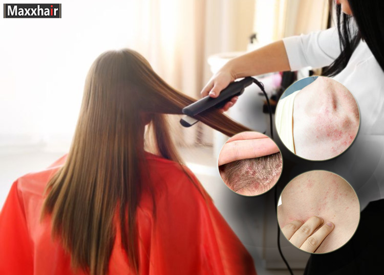 Vùng da sau đầu là bộ phận dễ bị dị ứng sau khi tiếp xúc với các hóa chất ép tóc
