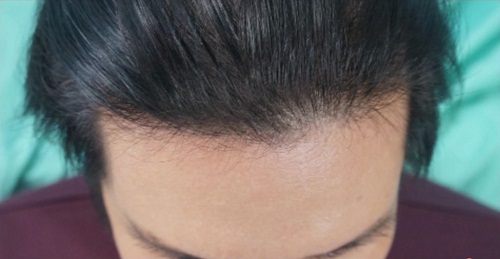 Cách ngăn rụng tóc hiệu quả do da đầu nhờn và bết dầu 2