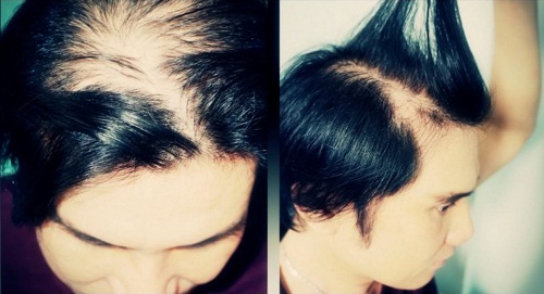 Cách ngăn rụng tóc hiệu quả do da đầu nhờn và bết dầu 1