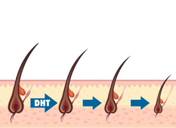 DHT- Thủ phạm của 80% trường hợp rụng tóc, hói đầu 1