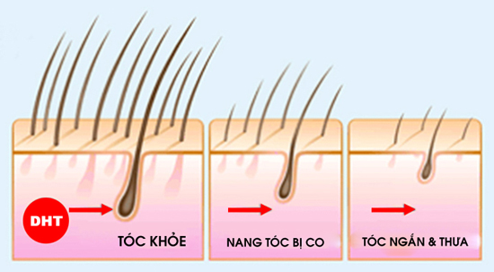 5. Nguyên nhân rụng tóc nhiều do da đầu nhiều dầu 1