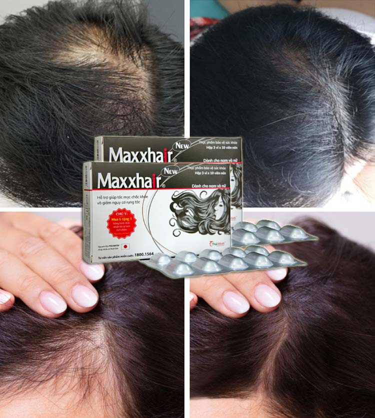 Hình ảnh trước và sau khi sử dụng Maxxhair 2 - 3 tháng của nhiều khách hàng
