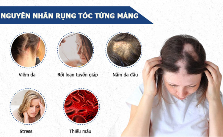 Nguyên nhân chính gây ra tình trạng rụng tóc thành từng mảng