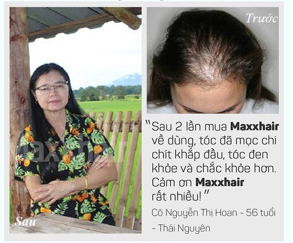 6 Lý do nên chọn Maxxhair để điều trị rụng tóc nhiều, hói đầu 10