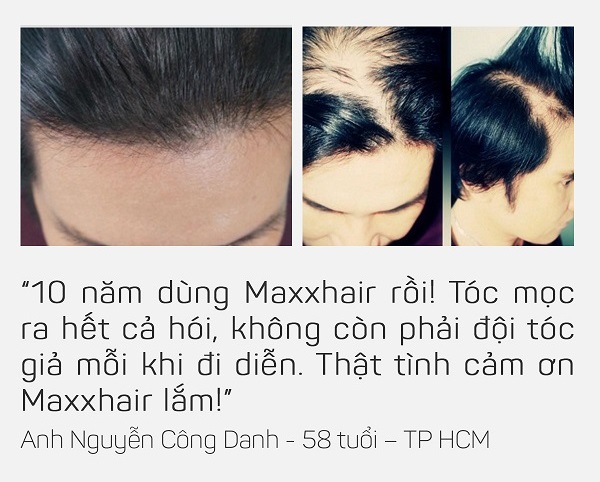 Tại sao nên chọn MAXXHAIR khi bị Rụng tóc nhiều, Hói đầu sớm? 6