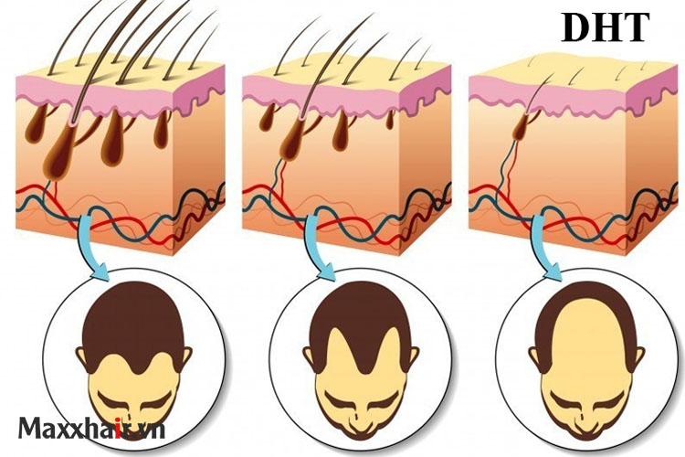 Nguyên nhân gây rụng tóc di truyền 1