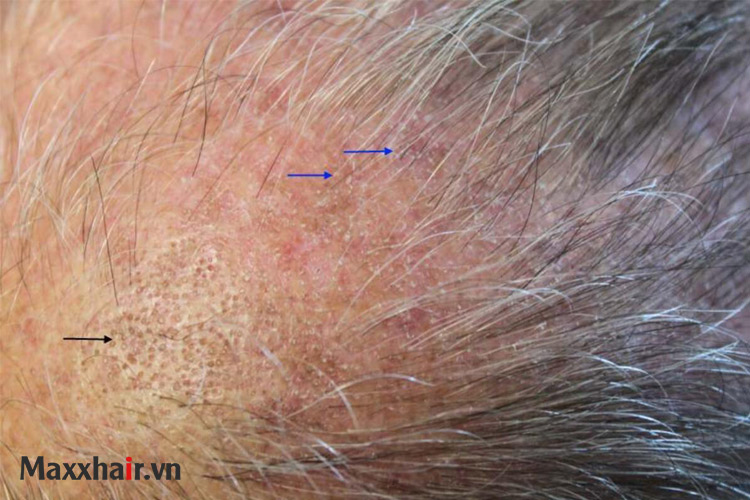 Bệnh lý viêm nhiễm trên da đầu 2