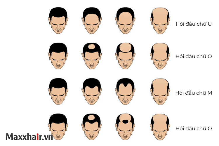 Triệu chứng hói đầu di truyền ở nam giới 1