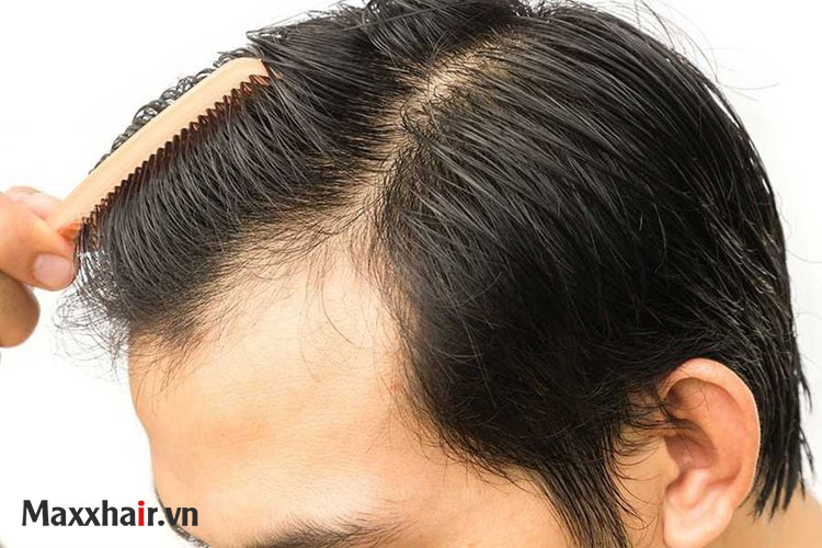 Rụng tóc toàn thể  Nguyên nhân và cách cải thiện hiệu quả