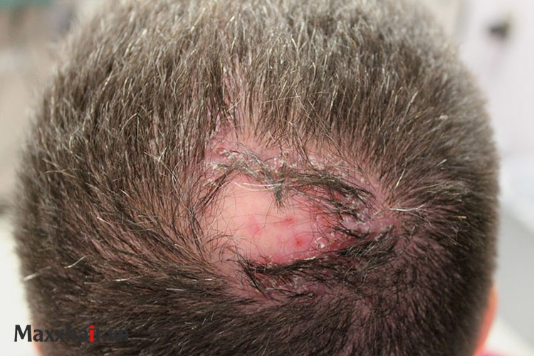 Bệnh lý viêm nhiễm trên da đầu 1