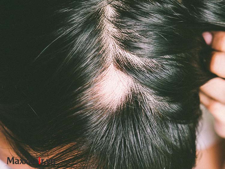 Rụng tóc do bệnh lupus ban đỏ 1