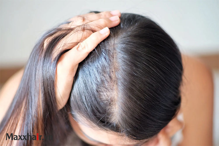 Nguyên nhân và cách điều trị tóc mọc thưa ở đỉnh đầu