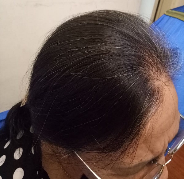 Tuổi cao không tránh khỏi rụng tóc, bạc tóc 1
