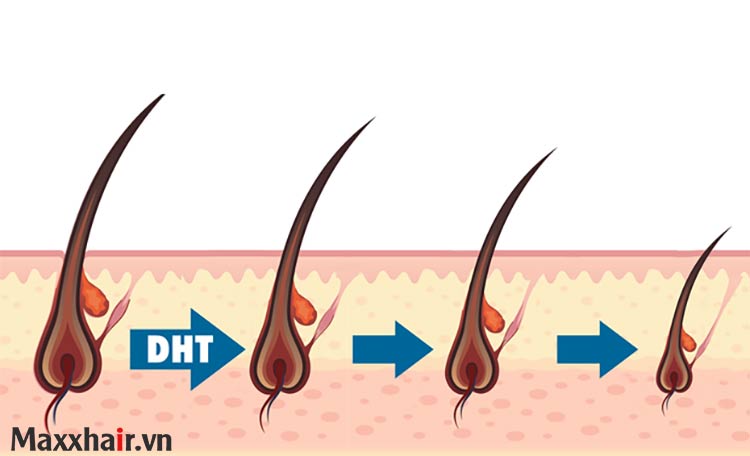 Comment la DHT provoque-t-elle la chute des cheveux ?  première
