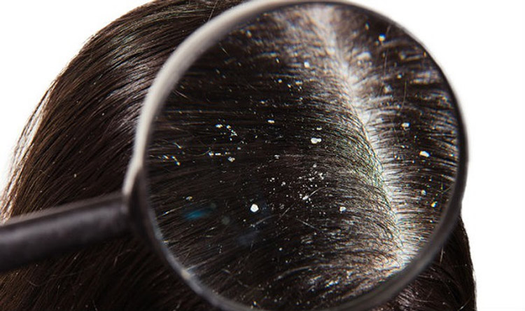 Tình trạng tóc rụng có hạt trắng có thể ảnh hưởng tới thẩm mỹ và sức khỏe tinh thần