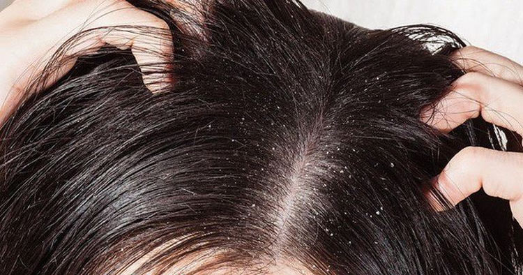 Tóc rụng có hạt trắng ở chân tóc thường bị nhầm lẫn với gàu