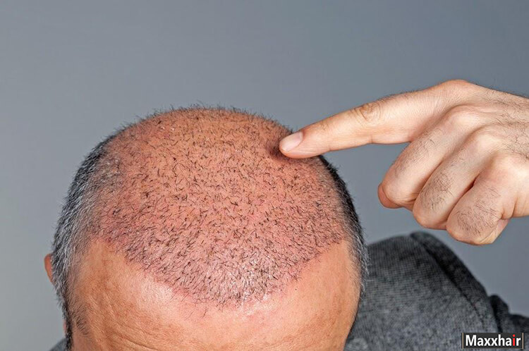 Phương pháp cấy tóc tự thân giúp điều trị tình trạng mất tóc do nhổ
