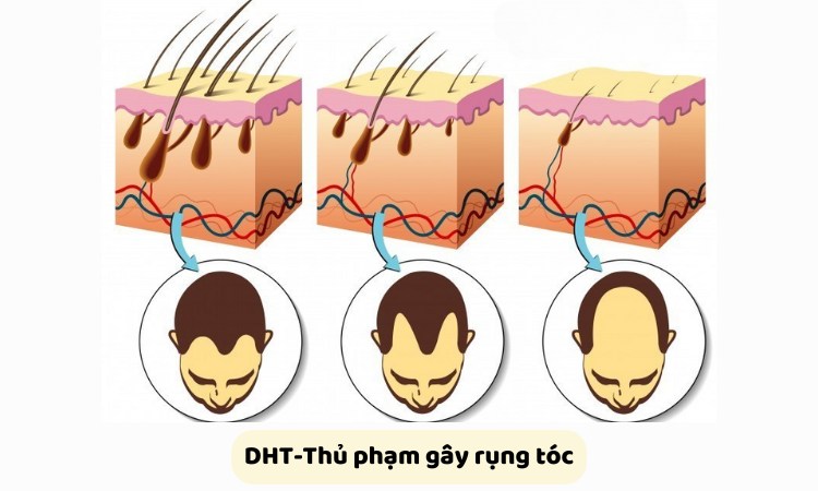 DHT khiến nang tóc bị thu nhỏ và tóc gãy rụng