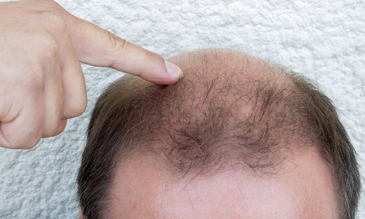 Kiểu rụng tóc Androgenetic Alopecia mà nhiều nam giới đang gặp phải