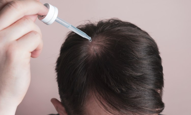 Minoxidil được chỉ định trong điều trị rụng tóc hiện nay