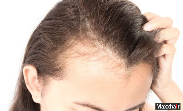 Có nhiều nguyên nhân khác nhau gây ra tóc mọc không đều