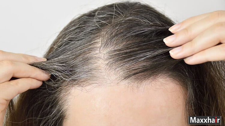 Tóc bạc hoàn toàn có thể mọc lại được nếu nang tóc không bị hư tổn