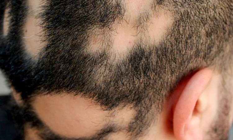 Những triệu chứng thường gặp phải khi bị rụng tóc hình đồng xu