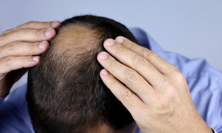 Rối loạn tự miễn là một trong các nguyên nhân khiến nam giới rụng tóc