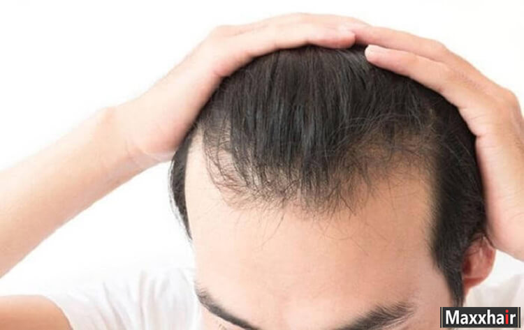 Vuốt tóc nhiều không bị hói mà còn do nhiều nguyên nhân khác